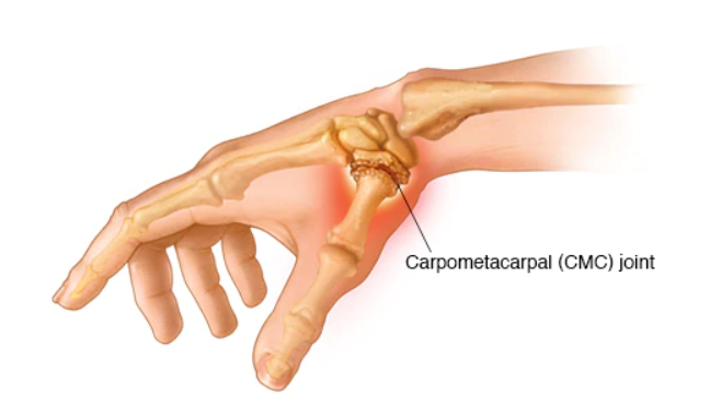 osteoarthritis first metacarpophalangeal joint